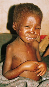 Kwashiorkor. &Oslash;demer i ansikt og p&aring; hender og f&oslash;tter. Tilstanden skyldes trolig proteinmangel og elektrolyttforstyrrelse&hellip;