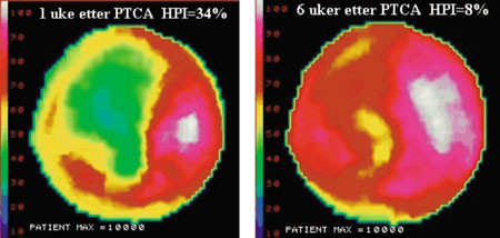 Figur 2  Myokardperfusjonsscintigram av venstre ventrikkel (bull&rsquo;s eye plot) hos en 54 &aring;r gammel mann etter vellykket prim&aelig;r&hellip;