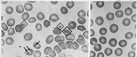 Figur 3   Blodutstryk 1975, s&oslash;nn. Merk de mange unormale former av de r&oslash;de blodcellene, og spesielt Howell-Jolly-legemene &hellip;