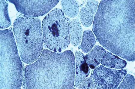 Figur 4   Muskul&aelig;re aggregater fra affisert s&oslash;nn. Farget med NADH-tetrazolinreduktase. Preparat og foto Kari Skullerud,&hellip;