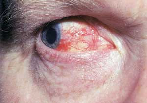 Figur 3   &Oslash;yet til en tarantellforsker etter eksponering for tarantellh&aring;r. I dette tilfellet valgte pasienten egenbehandling&hellip;