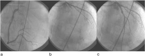 Figur 1 Tre angiogrammer av hjertet til en 77 &aring;r gammel mann med fremreveggsinfarkt: a) Koronarangiografi av h&oslash;yre krans&aring;re&hellip;