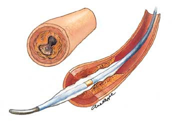 Prinsipp for koronar angioplastikk: En tynn ledesonde f&oslash;res fra lyskearterien via hovedpuls&aring;ren til den okkluderte&hellip;