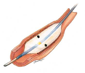 Ballongen bl&aring;ses opp og presser avleiringene inn i karveggen.