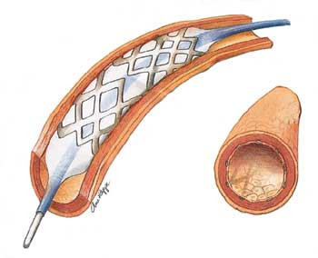 For &aring; holde passasjen &aring;pen, legges en stent (tynt r&oslash;r) inn i karet i 80 % av tilfellene. Illustrasjon Ane Reppe