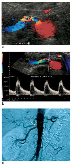 Figur 2 a) Signifikant stenose ved avgangen av h&oslash;yre nyrearterie (okkludert venstre) hos 64 &aring;r gammel kvinne med&hellip;