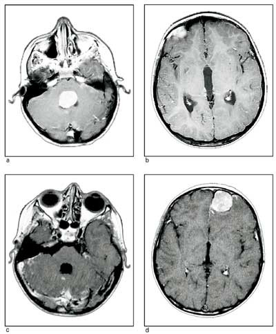 Figur 2 a og b) Preoperative T1-vektede aksiale MR-snitt med kontrast hos et barn med medulloblastom i bakre skallegrop&hellip;