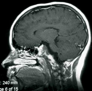 Figur 2 b) Postoperativ sagittal MR-unders&oslash;kelse med kontrast av kordom i clivus