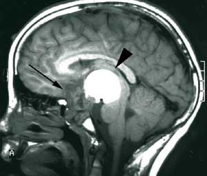 Figur 3 a) Preoperativ sagittal MR-unders&oslash;kelse med kontrast av kraniofaryngeom. Svulsten har en solid komponent (pil) og en&hellip;