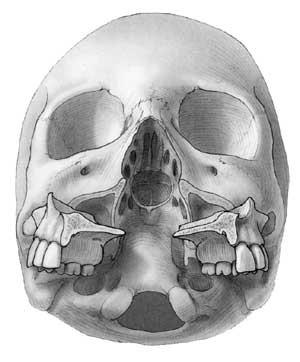 Figur 5 Maxilla nedfrakturert og utadrotert (LeFort I-osteotomi, midtlinjemaksillotomi og pallatomi)