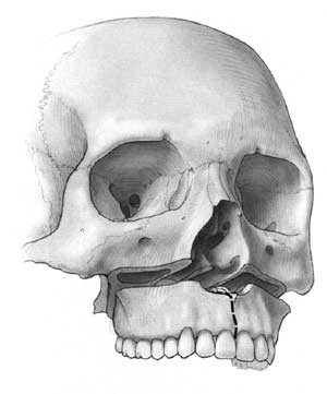Figur 4 LeFort I-osteotomilinjene