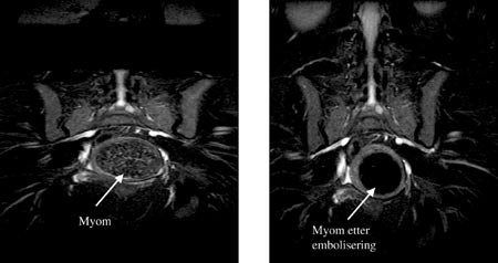Figur 2 MR-bilde i koronarplan. Stort intramuralt myom f&oslash;r og ni m&aring;neder etter embolisering. Moderat reduksjon i volum og&hellip;