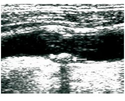 Figur 2 H&oslash;yekkogent plakk. Gr&aring;toneskalabilde av plakk (pil) med blandet ekkogenisitet, hovedsakelig h&oslash;yekkogent