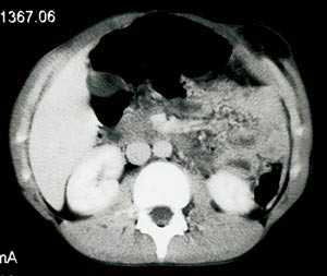 Figur 2 CT abdomen av pasient 2 viser en defekt i bukveggen lateralt for rectusskjeden med herniering av tynntarm