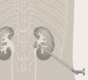 Perkutan nefrolitotomi. Nefroskopet p&aring; plass i nyrebekkenet