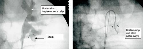 Figur 3 Ureterorenoskopi. Fleksibelt ureteroskop inspiserer samlesystemet i nyren og manipuleres mot stein i nedre calyx