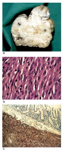 				Figur 2  a) Ekstirpert gastrointestinal stromal tumor fra tynntarm hos 45 &aring;r gammel mann. St&oslash;rste diameter er 6 cm, og&hellip;
