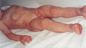 Figur 2  Pasient 1 to &aring;r og to m&aring;neder gammel (august 2002)