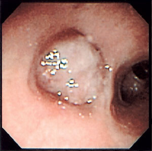 Figur 3  Bronkialt karsinoid som okkluderer venstre underlappsbronchus hos en 48 &aring;r gammel kvinne