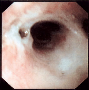 Figur 4  Etter andre gangs laserbehandling, som foregikk i lokalbed&oslash;velse, er det blitt et lite &laquo;krater&raquo; der hvor&hellip;