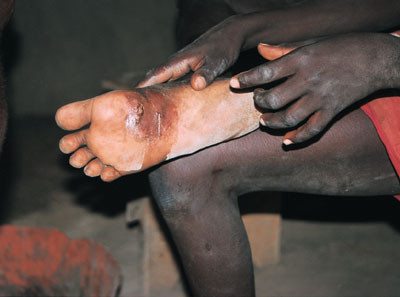 En lang orm p&aring; vei ut av fots&aring;len til en ung gutt.