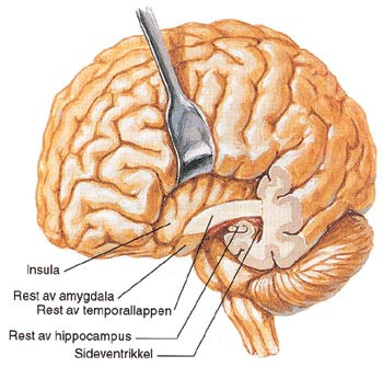 Figur 2  Temporal lobektomi