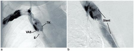 Figur 2  Venografisk fremstilling av v. cava superior som viser stenose (S), kaudale ende av ventrikuloatriale shunt (VAS)&hellip;