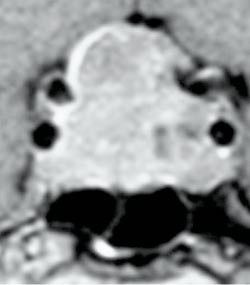 Figur 2  Tumor med lateral og suprasell&aelig;r utbredelse. Svulsten har invadert sinus cavernosus og vokser delvis rundt&hellip;