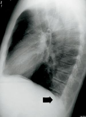 Figur 3  Standard r&oslash;ntgenbilder av thorax gir mistanke om fortetning ned mot dorsale sinus (lukket pil)
