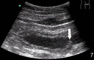 Figur 3  Litt v&aelig;ske i antrum hos en mann med smerter i epigastriet i tre m&aring;neder. P&aring; bakre vegg n&aelig;r angulus (h&oslash;yre del av&hellip;