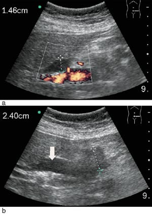Figur 4  Mobilskanning under visitten p&aring; en 67-&aring;rig kvinne med stille icterus. Funn: a) dilaterte intra- og ekstrahepatiske&hellip;