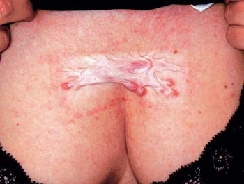Figur 2   Utvikling av keloid presternalt etter b&aring;tformet eksisjon av n&aelig;vus. Bindevevsdanningen vokser utover den&hellip;