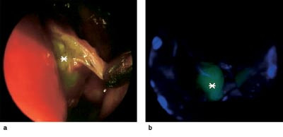 Figur 3  Intraoperativt endoskopisk bilde med fluorescerende cerebrospinalv&aelig;ske (asterisk) i sinus sphenoidalis a) uten og b&hellip;