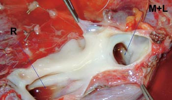 Figur 2  Lever etter at tumor og v. cava er fjernet. Munningen av h&oslash;yre (R) samt midtre og venstre (M+L) levervene er&hellip;