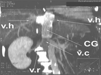 Figur 4  En CT-unders&oslash;kelse viser forholdene postoperativt med levervener (v.h) som munner ut i cavaprotesen (CG). H&oslash;yre&hellip;