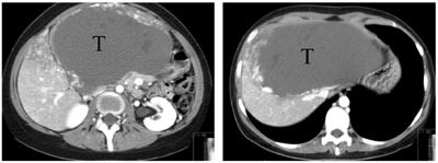 Figur 5  To CT-snitt viser en meget stor tumor (T) som inntar hele venstre leverlapp