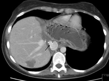 Figur 9  Postoperativ CT viser autotransplantatet med levervener som via en kort protese munner ut i v. cava-protesen (&AElig;)
