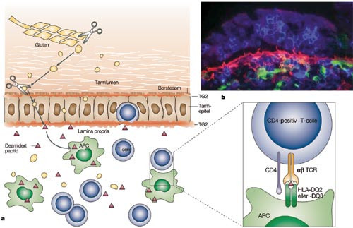 Figur 2  Tynntarmslesjonen ved c&oslash;liaki. Skjematisk fremstilling av tarmmucosa, med spesiell vekt p&aring; faktorer som er av&hellip;