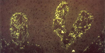 Figur 2  Typiske granul&aelig;re nedslag av IgA &oslash;verst i dermale papillespisser ved immunfluorescens av perilesjonal hudbiopsi ved&hellip;