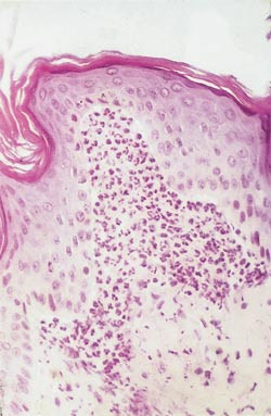 Figur 3  Histopatologisk unders&oslash;kelse av hudbiopsi ved en tidlig lesjon ved dermatitis herpetiformis: ansamling av&hellip;