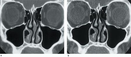 Figur 2  a) CT-bilde eksponert med standarddose gjennom det ostiomeatale kompleks. Snittykkelse 3 mm og str&oslash;mstyrke 200 mA i&hellip;