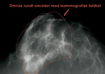 Figur 1b  Operat&oslash;ren tegner et r&oslash;dt omriss som inneholder lyse omr&aring;der med mammografisk tetthet. Dette omrisset inneholder&hellip;