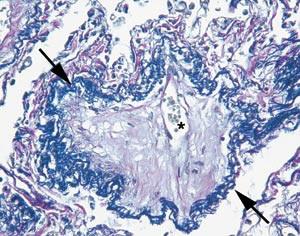 Figur 2  Tverrsnitt av liten lungevene med nesten oblitererende, l&oslash;smasket intimafibrose. Den ytre elastiske membran er&hellip;