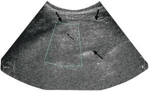 Figur 3  42 &aring;r gammel mann med smerter og palpabel oppfylling like til h&oslash;yre for umbilicus. Dette ultrasonogrammet viser den&hellip;