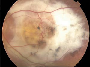 Figur 4  Aldersrelatert maculadegenerasjon: utbrent v&aring;t type med store, hvite subretinale arr. Visus nedsatt til lyssans