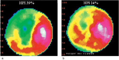 Figur 2  a) Myokardperfusjonsscintigrafi etter en uke viser infarktutbredelse (gr&oslash;nt omr&aring;de) i store deler av venstre&hellip;