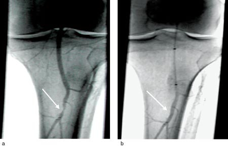 Figur 2  Angiografisk bilde av stenose (pil) i truncus tibiofibularis p&aring; leggen, a) f&oslash;r og b) etter PTA (okkludert a&hellip;
