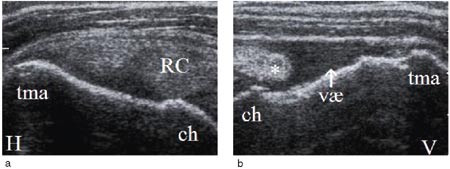 Figur 8  Lateral-longitudinal projeksjon av begge skuldrene: a) Normale forhold p&aring; h&oslash;yre side (H) med rotator cuff (RC),&hellip;