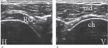 Figur 9  Lateral-transversal projeksjon av begge skuldrene: a) Normal rotatorcuff (RC) p&aring; h&oslash;yre side b) Venstre side med&hellip;