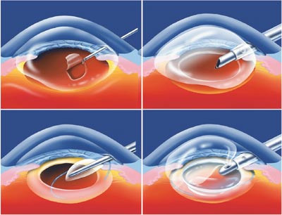 Figur 1&thinsp;&ndash;&thinsp;4  Hovedtrinn i kataraktoperasjon: capsulorhexis (fig 1), dvs. etablering av en sirkul&aelig;r &aring;pning i fremre&hellip;